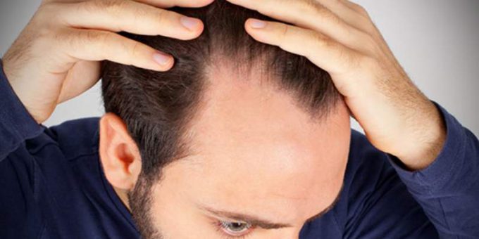 caduta_capelli_uomo_800x449