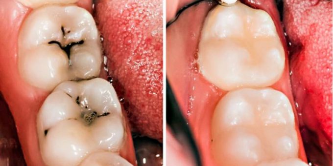 carie-e-pulizia-dei-denti-6